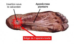 Aponévrosite plantaire